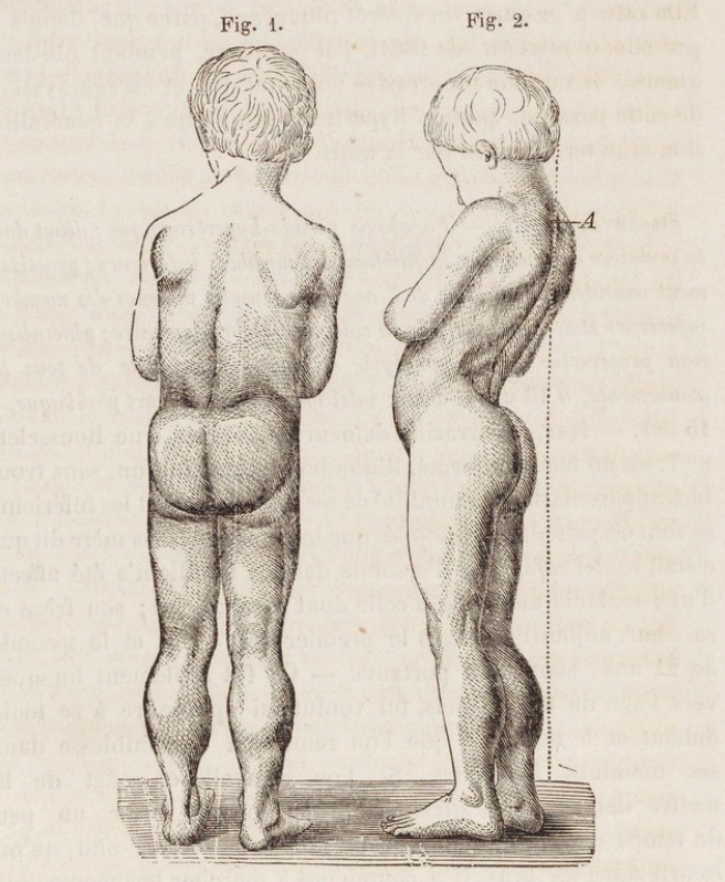 Like many genetic disorders, we’ve known about Duchenne muscular dystrophy for centuries